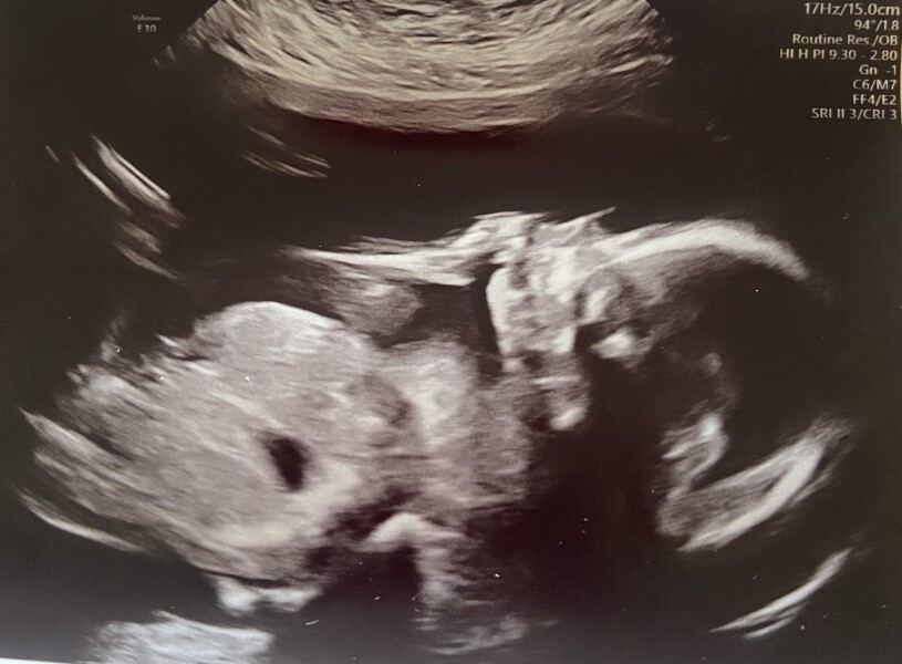 20 week anomaly scan (gender guess) 