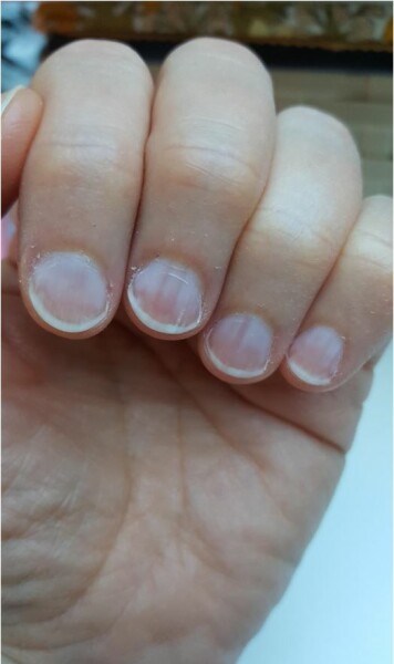 Diagnose what my diet is missing by the state of my bleached nails - pic attached