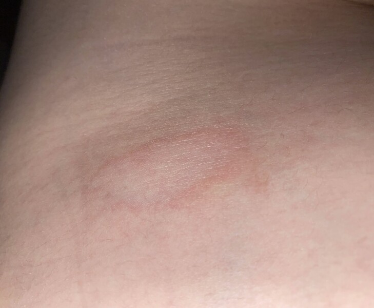 Can anyone help me identify this rash please?
