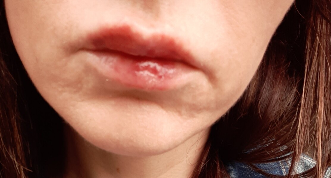 Lip filler and my lesson in self acceptance 