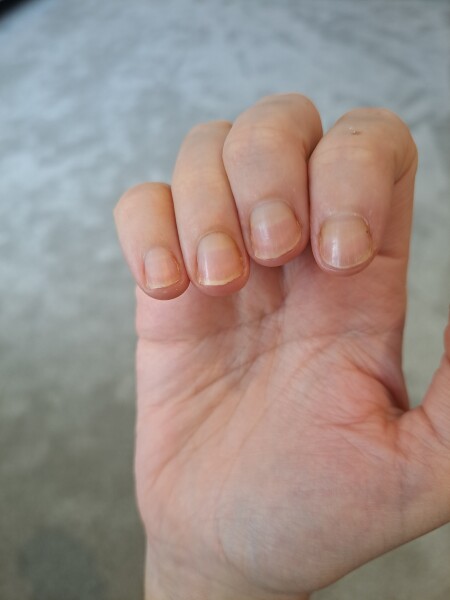 What's happening to my fingernails?
