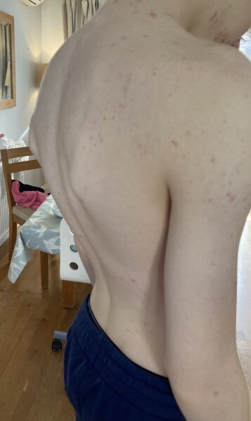 To get a second opinion on my sons back - photos attached 