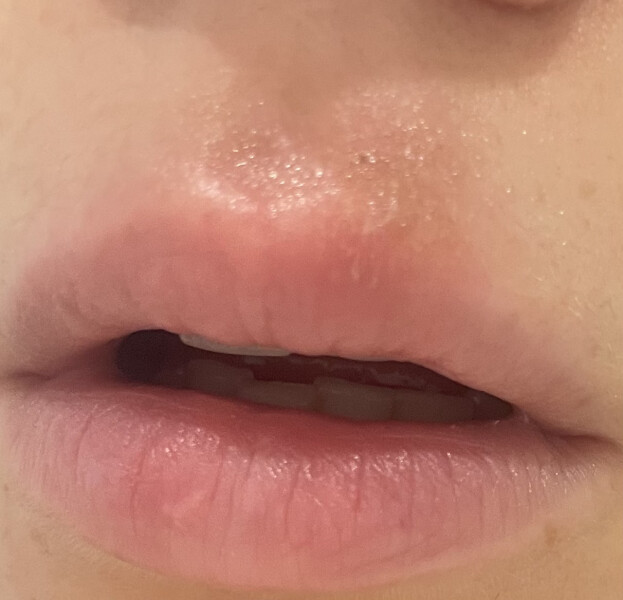 I've got my first cold sore ever and I'm about to get married