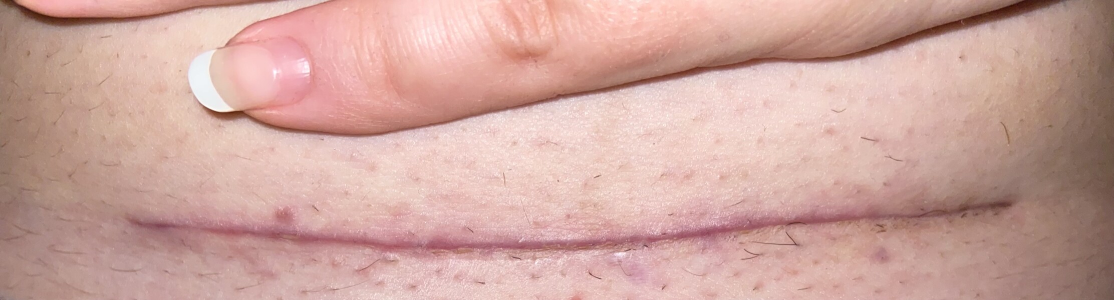 Csection scar healing?