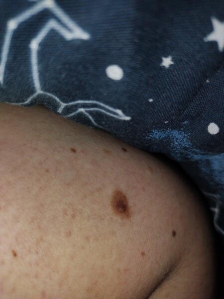 A mole on my arm looks weird 