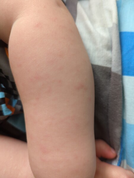 Quickly developing rash on toddler 
