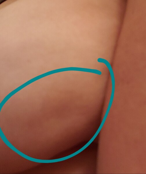 Dents in breasts
