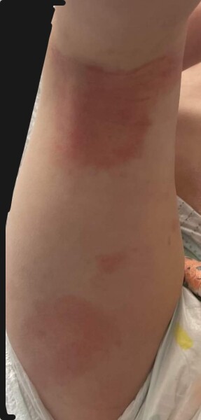 Can anyone help me identify my 2 year olds rash?