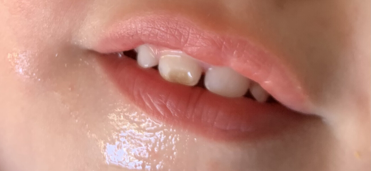 Baby bottle rot