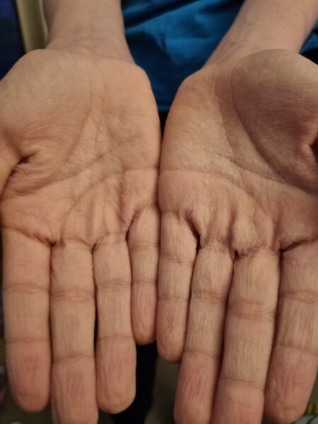 DS excessive hand wrinkling. Cystic fibrosis? So worried! 