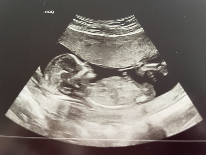 BFPs following IVF to take symptoms & scans