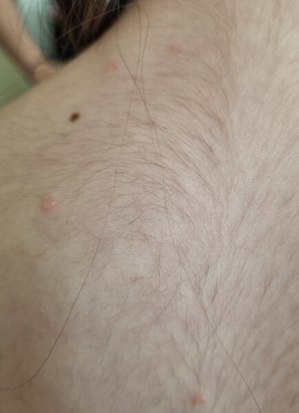 Is this chickenpox? 