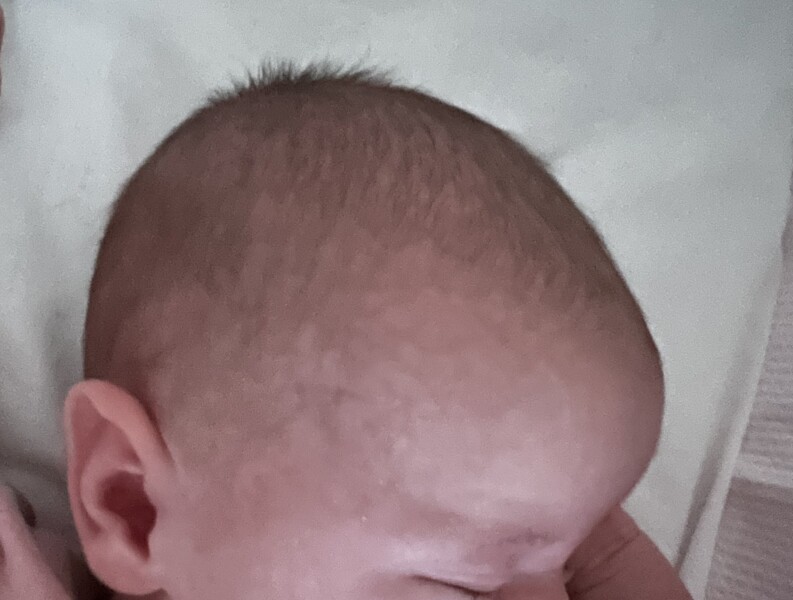 Baby abnormal head shape? - Thoughts please 
