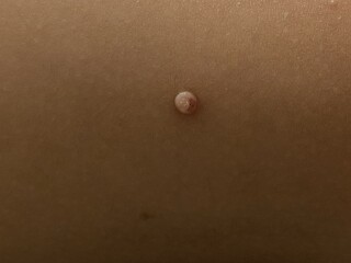 Molluscum Contagiosum?