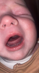 Thinking against tongue tie procedure?