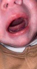 Thinking against tongue tie procedure?