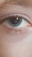 Any Opticians or Parents who might of seen in children can advise?