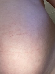 Red marks on stomach