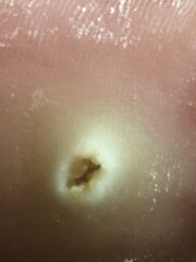 What the hell is this hole in my foot?