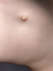 Chickenpox