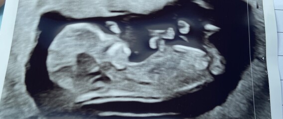 Boy or girl? No visible nub 