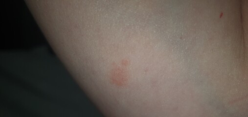 Ringworm?