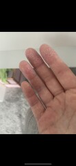 Extremely dry hands - pics attached