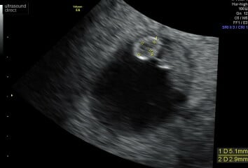 8 Week Scan Experiences please
