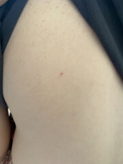 Worried about skin cancer :(