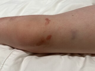 Any ideas about DDs weird rash? 