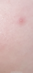 Chickenpox