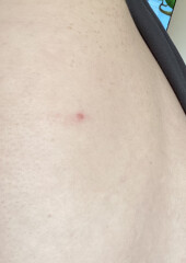 Worried about skin cancer :(