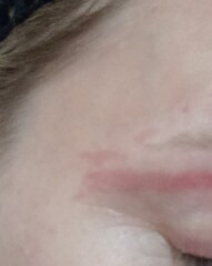 Salon lady waxed my eyebrows too hard