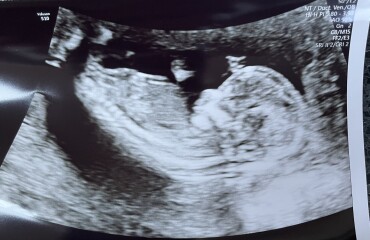 14 week scan - boy or girl? 