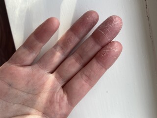Extremely dry hands - pics attached