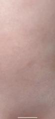 Chicken pox? 
