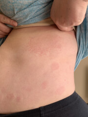 13 year old with severe hives