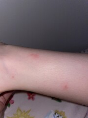 Molluscum Contagiosum?