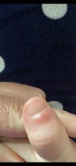 Sore thumb