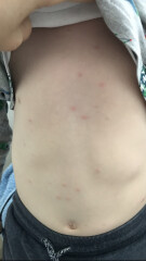 Chicken pox? 
