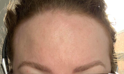 Has anyone managed to reduce wrinkles without Botox or filler?