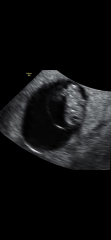 8 Week Scan Experiences please