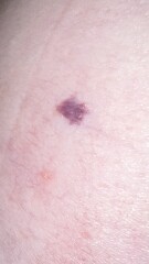 On a scale of 1-10, how worried would you be about this mole? Pic included. 