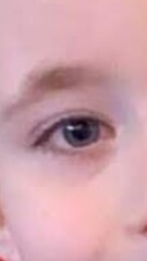 Any Opticians or Parents who might of seen in children can advise?