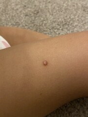 Molluscum Contagiosum?