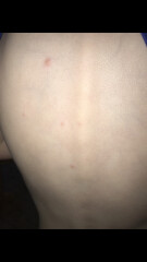 Chicken pox? 