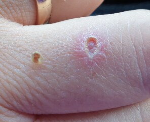 Just pulled scab off... *KLAXON*