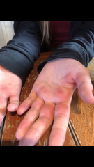 Does this sound like hand foot and mouth?