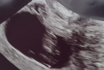 Does my ultrasound look like twins ?