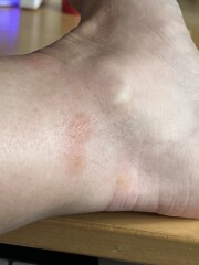 Do we have bedbugs or just fleas?